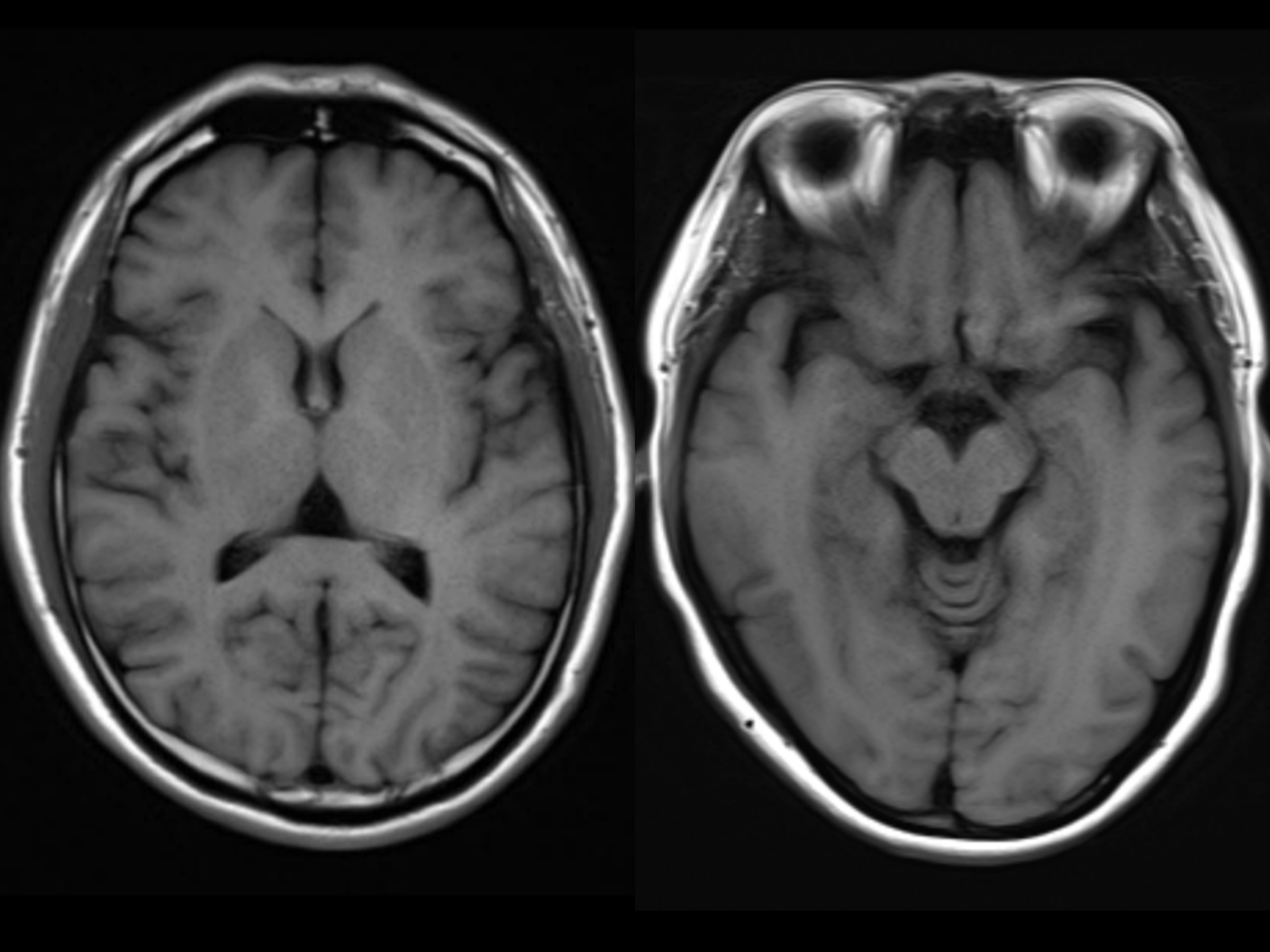 正常大脑和萎缩的大脑,ct和mri检查图像