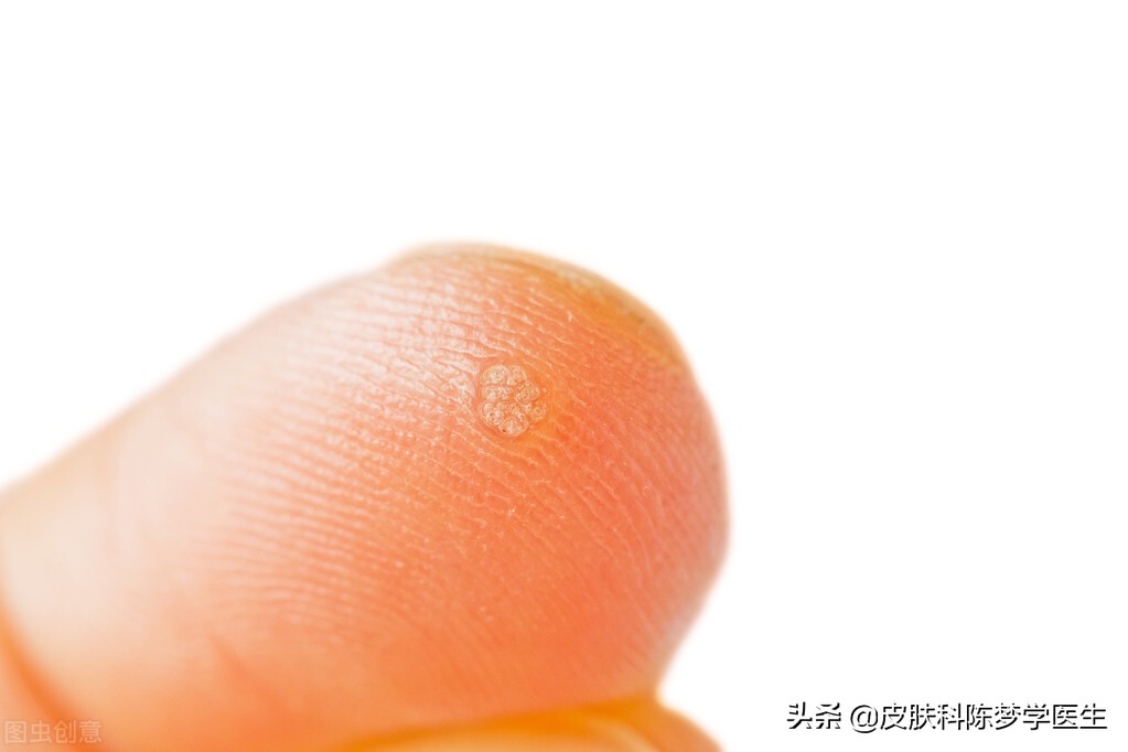 毛发红糠疹图片(长粉刺) - 赤虎壹号