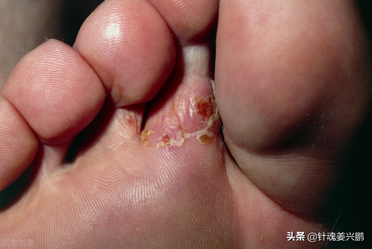 实际上,它的真名叫脚藓,是一种被真菌感染的皮肤病
