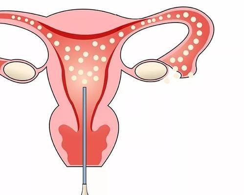 输卵管堵塞了，是吃药还是手术？