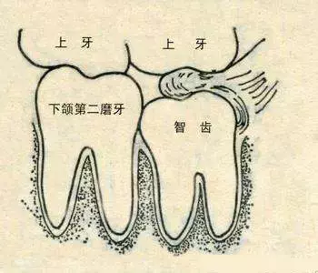 什麼叫智齒牙(什麼叫智齒牙,有什麼危害)
