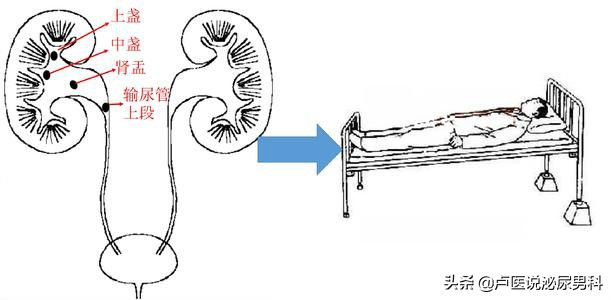 如果你患有尿路结石，准备通过“体外冲击波碎石”治疗，请看此文
