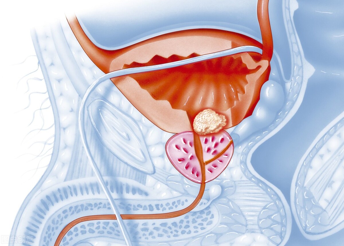 前列腺癌有什么症状？如何预防前列腺癌？
