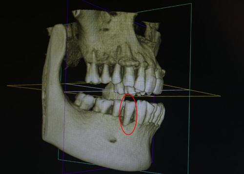 牙科的ct片相對其他牙片來講,無論是功能還是設備上都是比較高級的