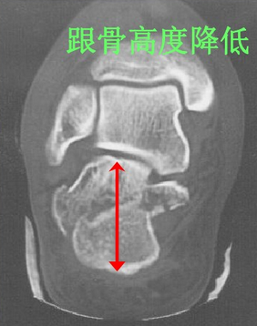 摔跤后脚后跟疼痛，警惕跟骨骨折，必要锻炼预防后遗症