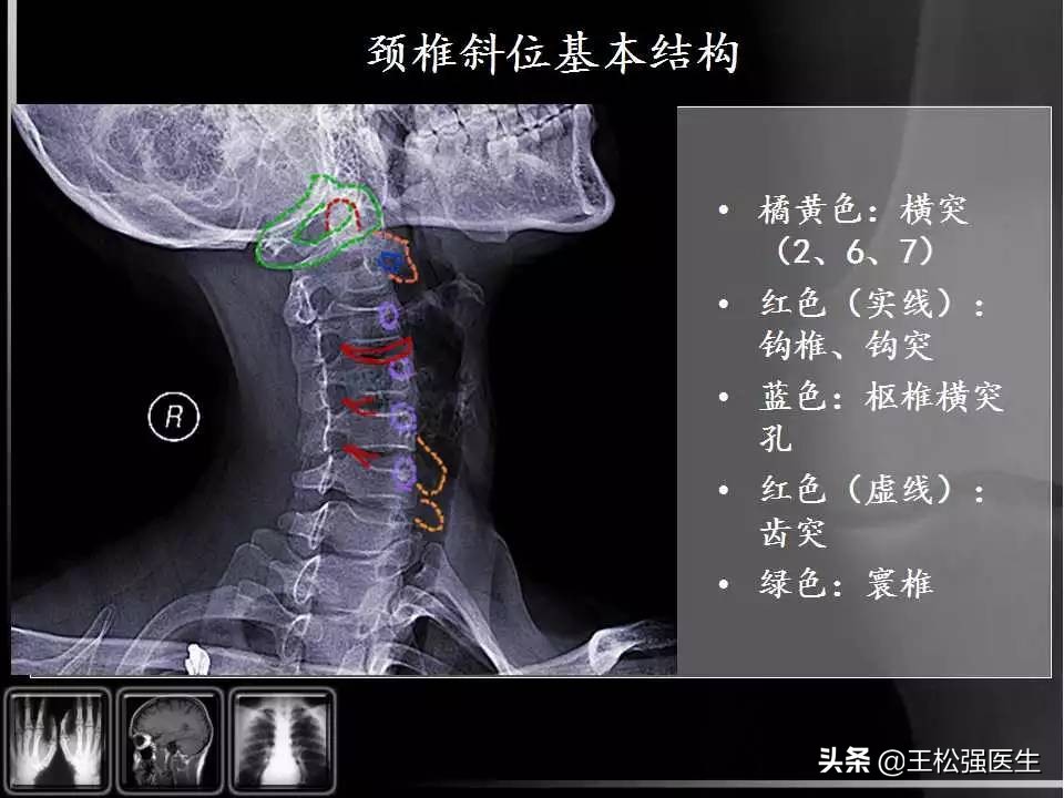 颈椎X光片