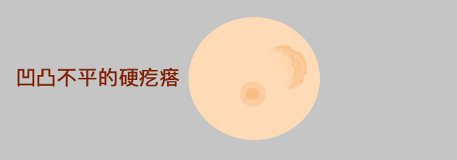乳腺结节到底是什么? 真相在这里！
