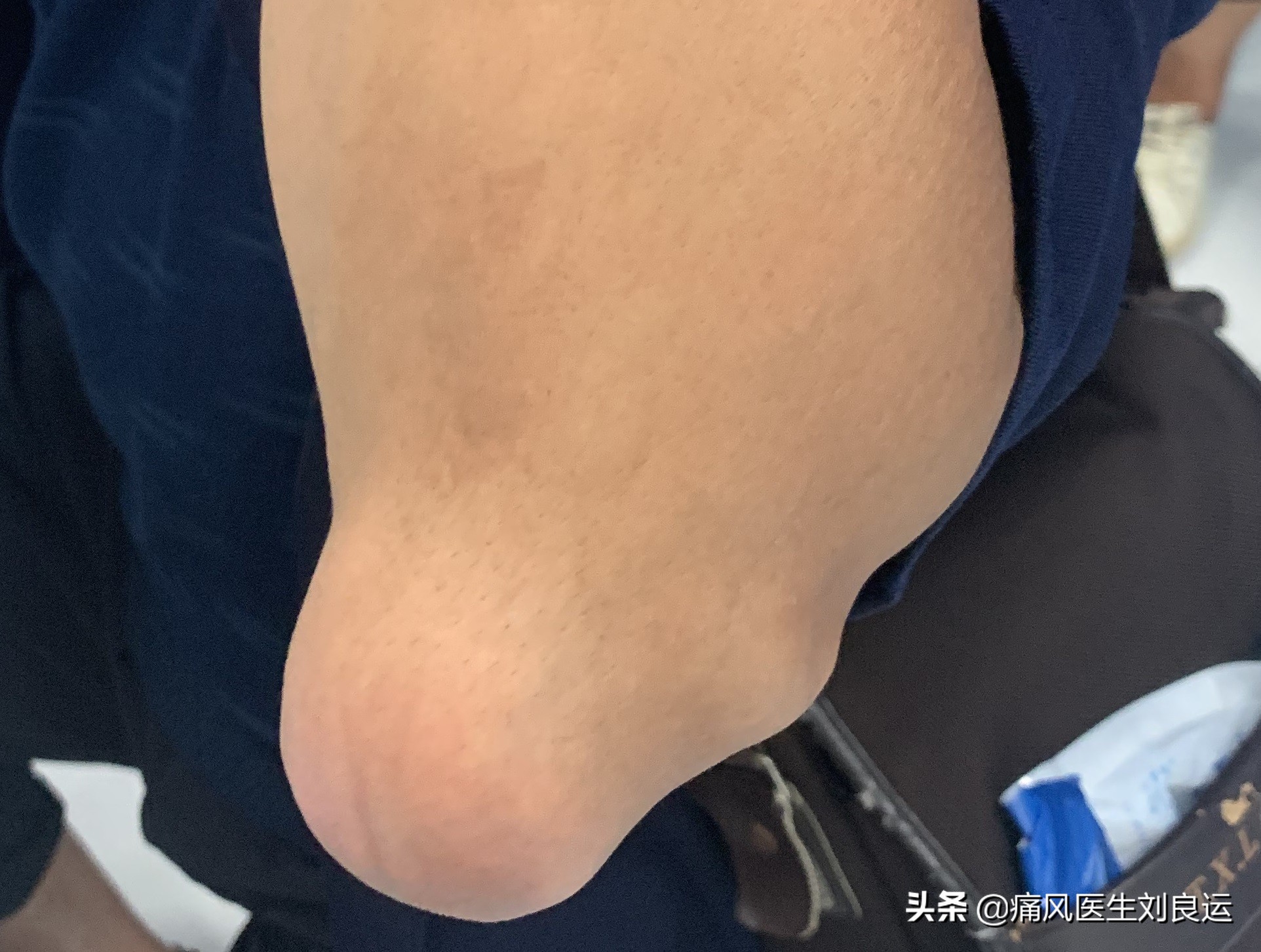 痛风患者都会长出痛风石吗？医生介绍痛风石治疗的四种方法