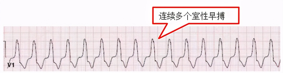 掌握常见心电图，我的心脏我做主