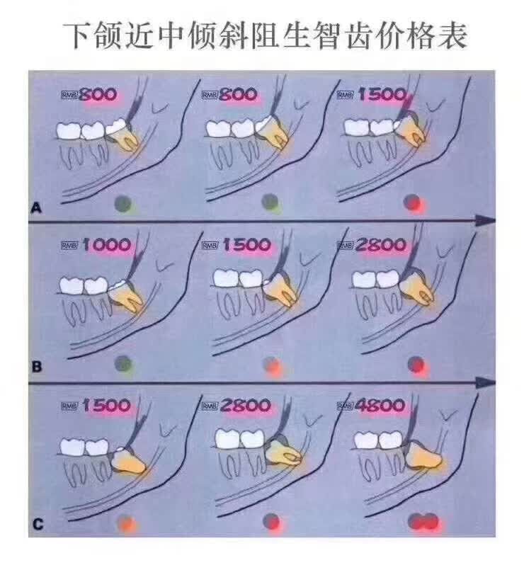 埋得越深，分手费越高—你所不知道的拔智齿收费依据