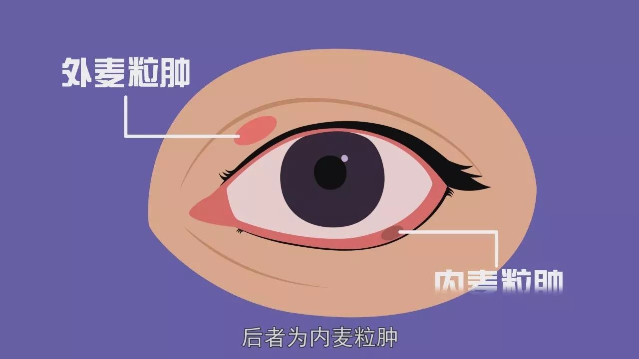 孩子得了麦粒肿怎么办？