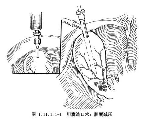 胆囊疾病什么情况需要手术？医生告诉你：切除只是其中一种方式