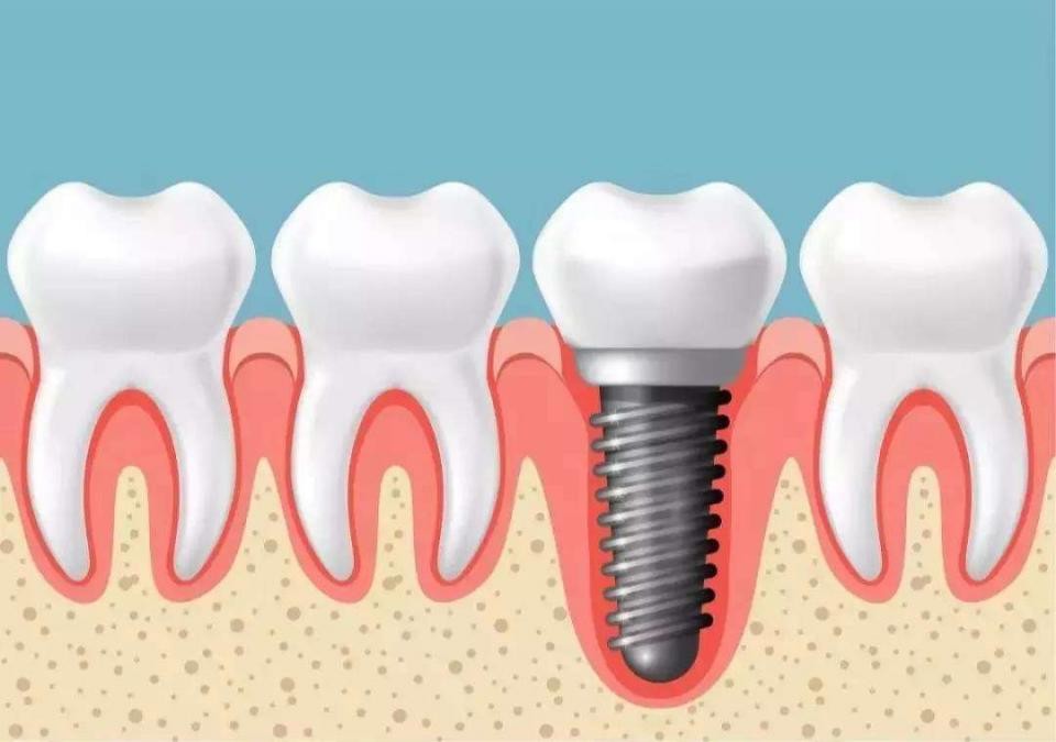 「牙齿那些事儿」No.37丨缺牙修复选种植牙，但这7类人要谨慎