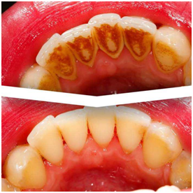 牙医解答大家对洗牙的几个常见误会，洗牙其实没那么可怕
