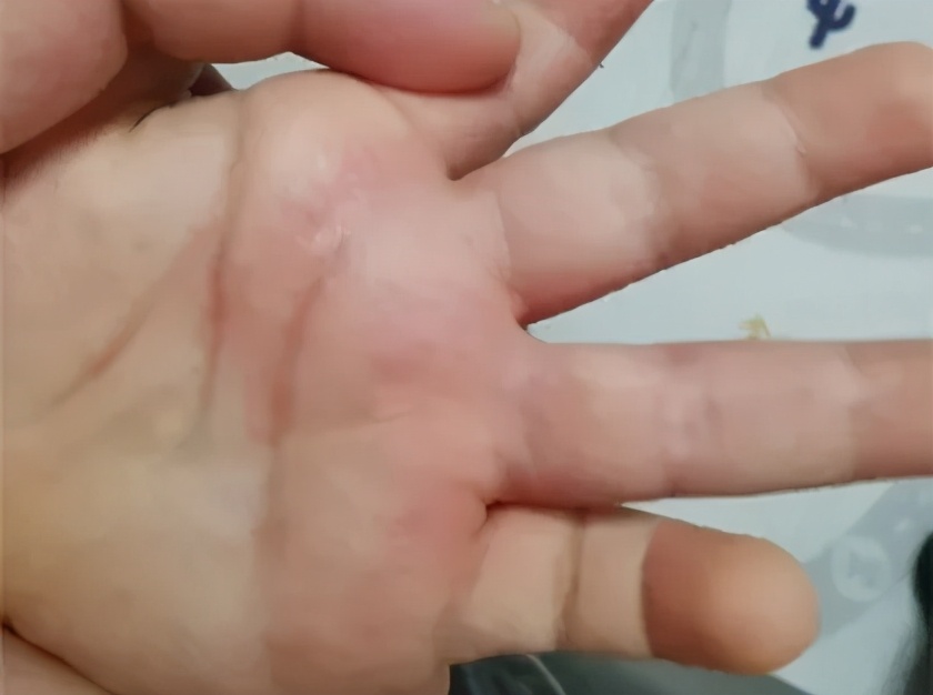 孩子手上起很痒的小疙瘩，是什么？怎么办？