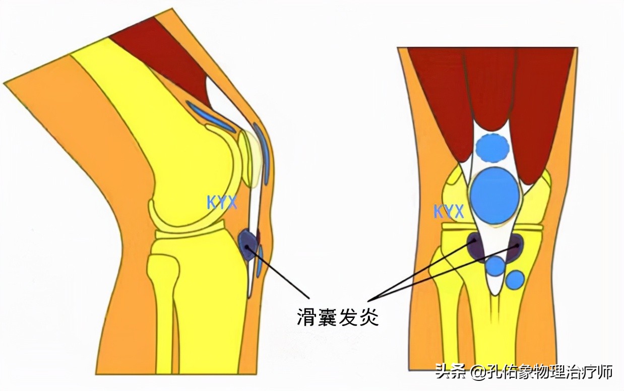 膝关节肿胀、积液、还伴疼痛，是啥原因引发的？该咋办？请看此文