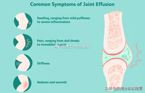 「运动康复科普」关节积液的出现机制与康复治疗