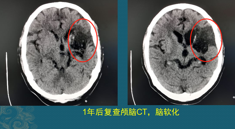 长年吃降压药副作用大？这2位病人后悔没吃药，没有后悔药了