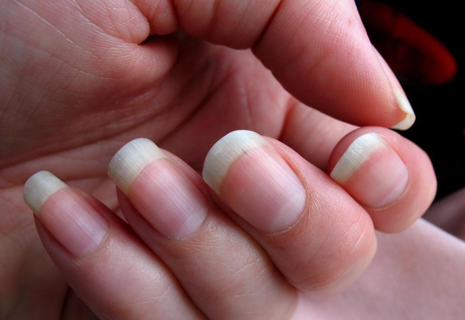 指甲上的月牙,白点代表什么?有些问题,别不当回事