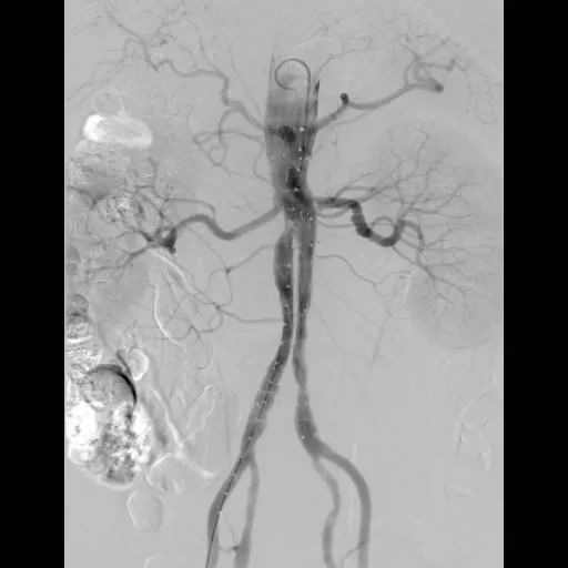 8小时完成高危病症手术，让患者一周出院，中国医大一院又实现新的突破！