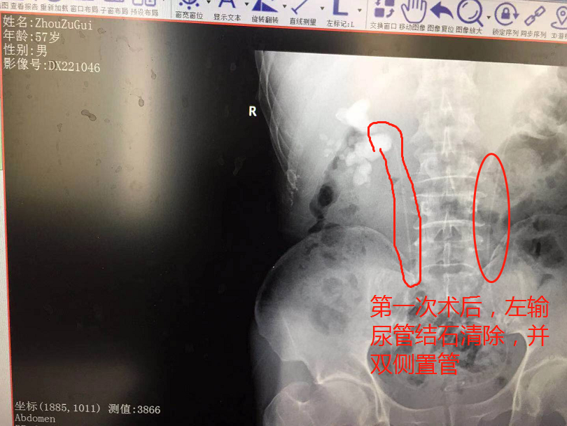 突发腰痛别小视！湖北大叔突感腰痛经查结石严重致肾功能受损