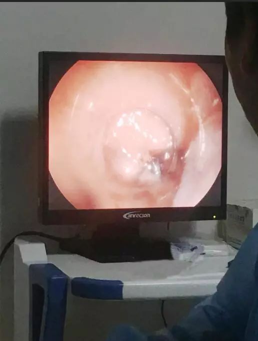 胃食管反流病的相关检查是什么？医生：都在这里了快自己对照