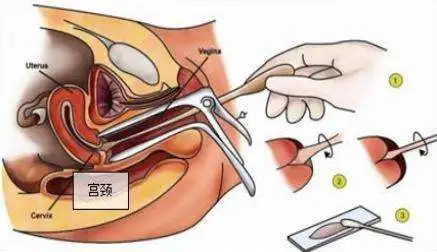 图片来源于网络那么,宫颈癌筛查时,tct检查正常,还用做阴道镜检查吗?