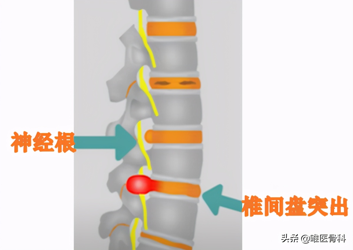 坐骨神经痛是什么引起的(为什么会「坐骨神经痛」？两大原因，一招区分)