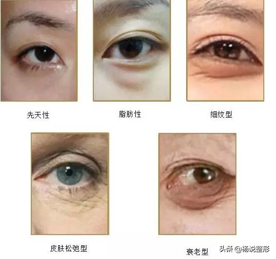 有效去除眼袋的方法与实用建议