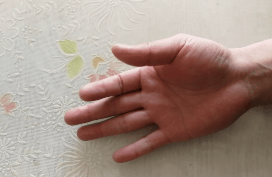 中老年女性常手指疼痛、肿胀，是腱鞘炎吗？该怎么办？告知您