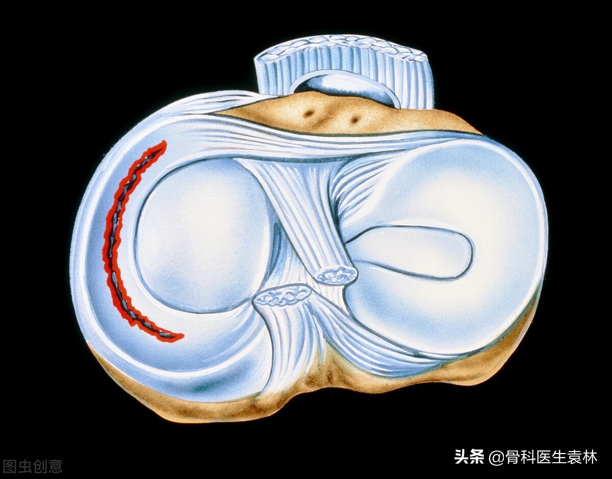 半月板损伤的最好治疗方法有哪些?