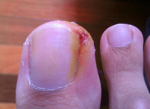 什么是"甲沟炎",该怎样预防呢