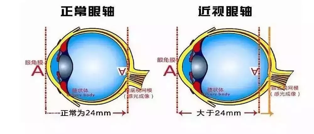 戴多久眼镜会变成死鱼眼？