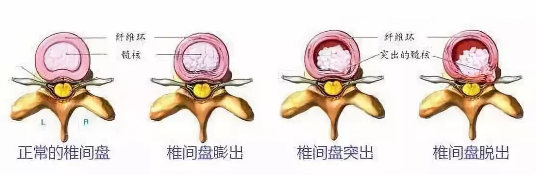 腰椎间盘突出打球戴护腰好吗(“腰椎间盘突出症”拍了拍你)