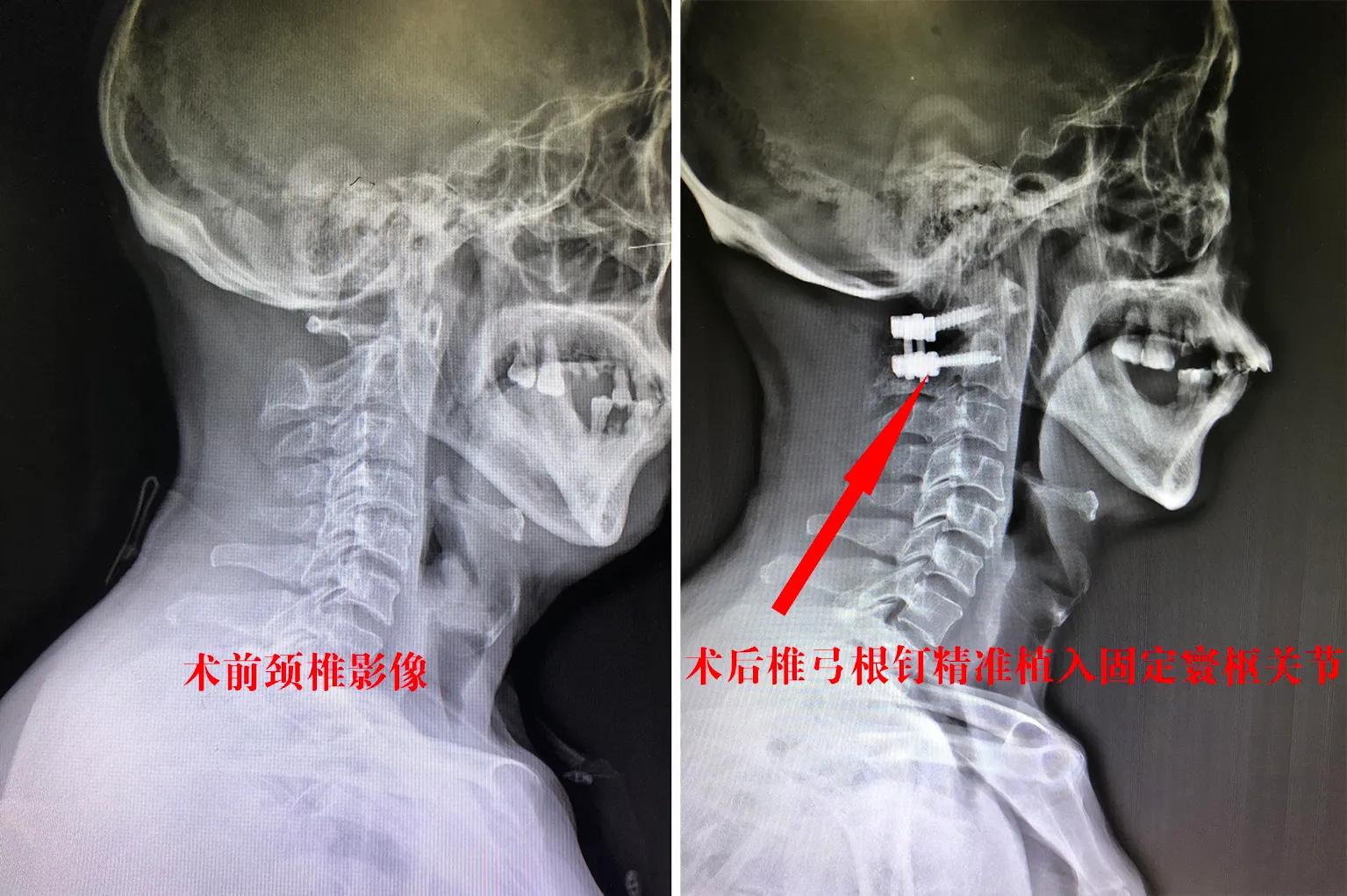 六旬老人“摔断”脖子，荆门二医脊柱外科勇闯“手术禁区”“四颗螺钉”巧固定