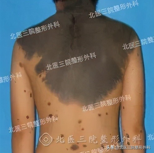 聊一聊：你熟悉的“痦子”