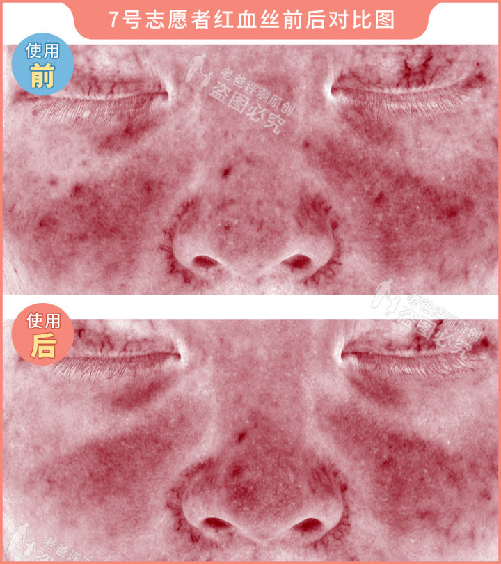 网红家用美容仪真的有效吗？2个多月的跟踪实测结果来了