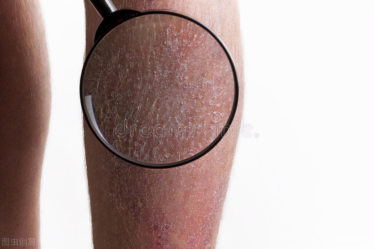 瘀斑的图片(血瘀生百病) - 赤虎壹号