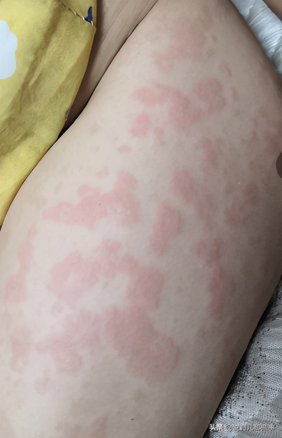 说说那些关于你不知道的过敏的事,内涵真实图片,慎入