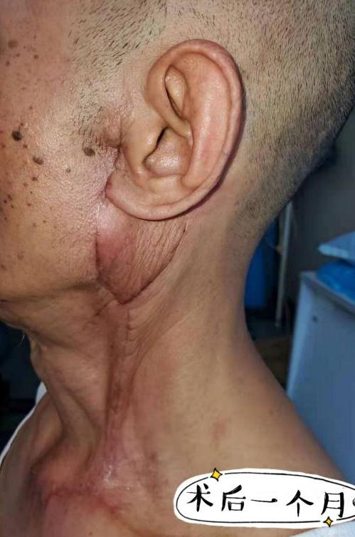 发现腮腺肿块要注意!耳后长"土豆"20多年竟成癌