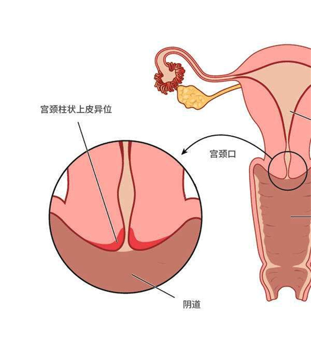 宮頸糜爛能自行恢復嗎?醫生闢謠來了