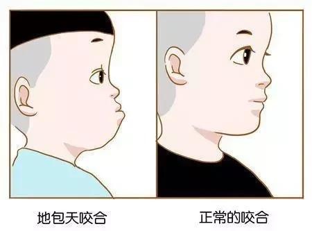 地包天矫正方法及治疗方案