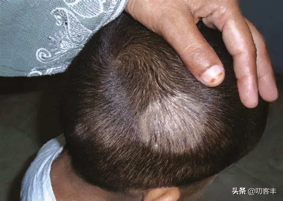 儿童头癣的初期图片(孩子得了头癣怎么办) - 赤虎壹号
