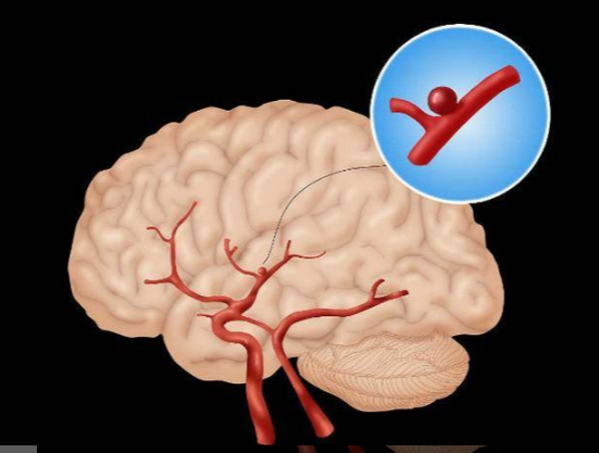 脑动脉瘤不是“肿瘤”，却为何比肿瘤更可怕？