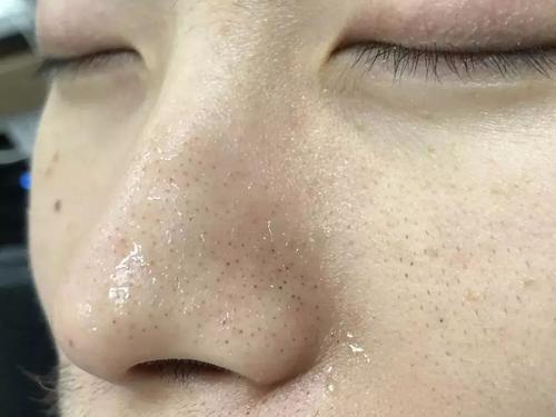 黑头粉刺图片(毛孔粗大还有黑头这不是要人命吗) - 赤虎壹号