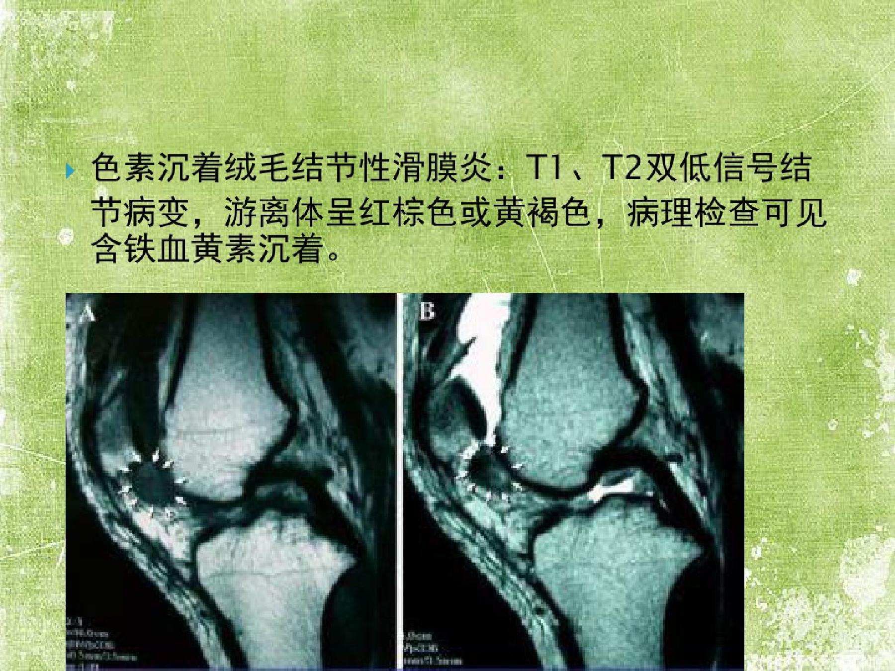 骨软骨瘤超声表现图片