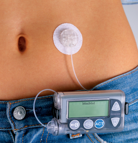 解放糖尿病患者的胰岛素泵,佩戴后可以放开吃喝吗?医生告诉你