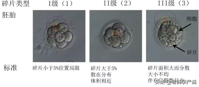 试管婴儿成功率高的医生，这样评估胚胎等级