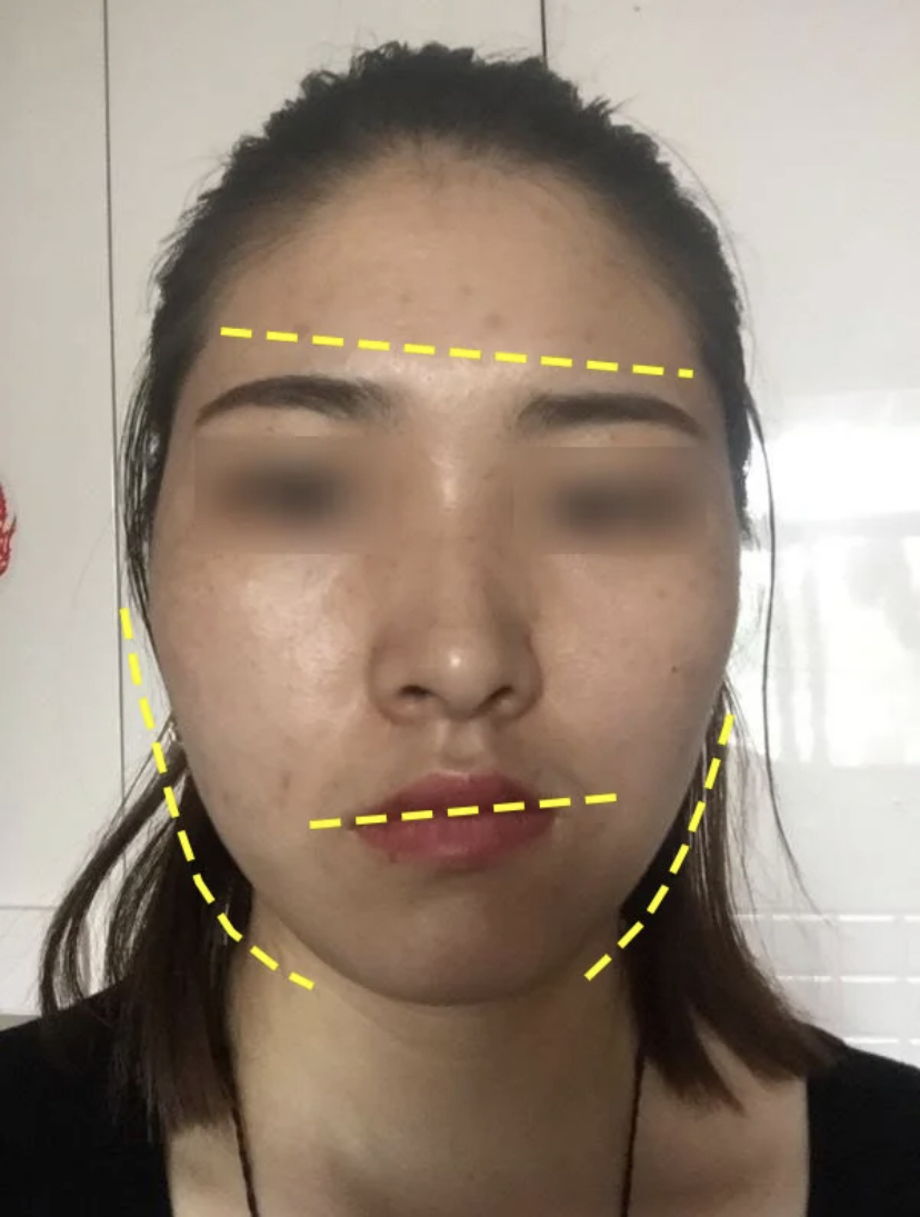 “大小脸”会影响颜值，来看看是怎样改善的，越早知道越好