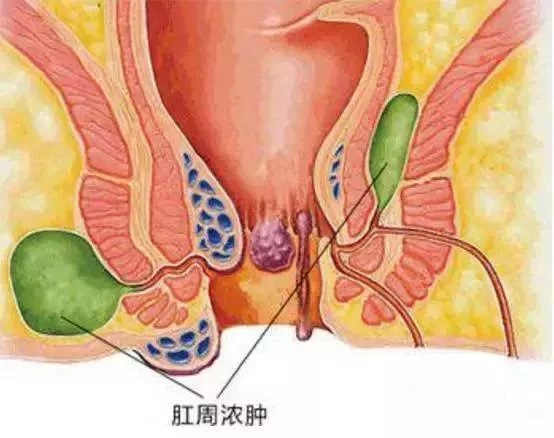 一顿小龙虾，屁股“被掏空”？肛周脓肿为啥找上门？